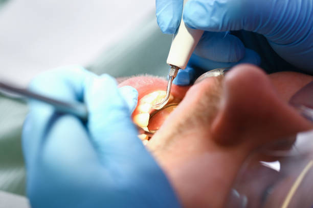 Best Urgent Care for Lost Fillings or Crowns in Nth Plains, OR