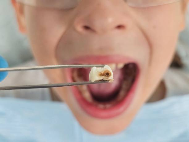 Best Emergency Dental Care for Broken or Chipped Teeth in Nth Plains, OR