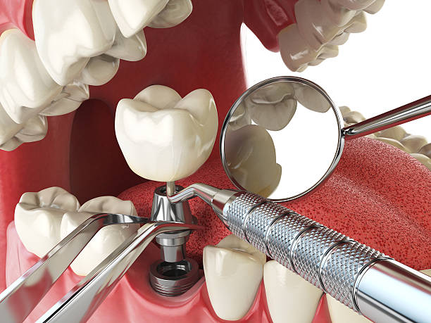 Best Emergency Treatment for Dental Infections or Abscesses in Nth Plains, OR